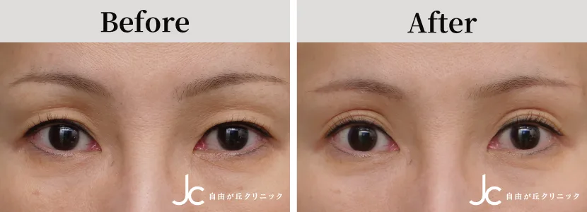 上まぶたのたるみ取りの症例写真