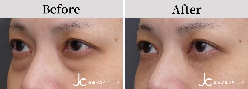 下まぶたのたるみ取りの症例写真