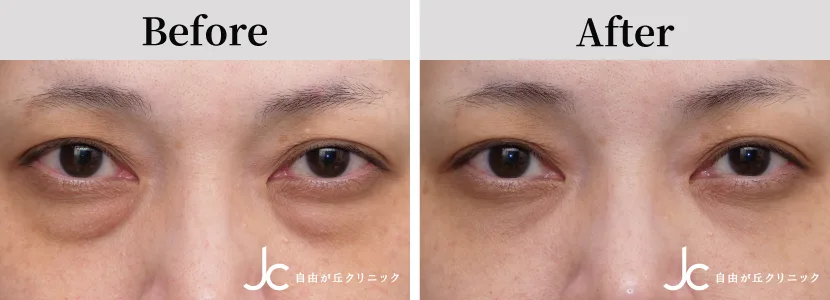 下まぶたのたるみ取りの症例写真