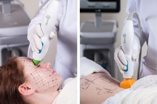 サーマクールFLX（高周波・たるみ治療）自由が丘クリニック【公式】