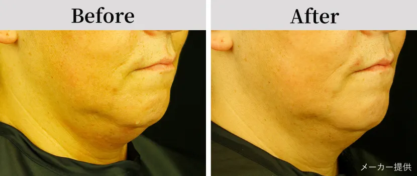 サーマクールFLX（高周波・たるみ治療）自由が丘クリニック【公式】