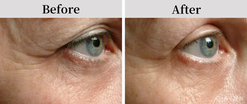 サーマクールFLX（高周波・たるみ治療）自由が丘クリニック【公式】