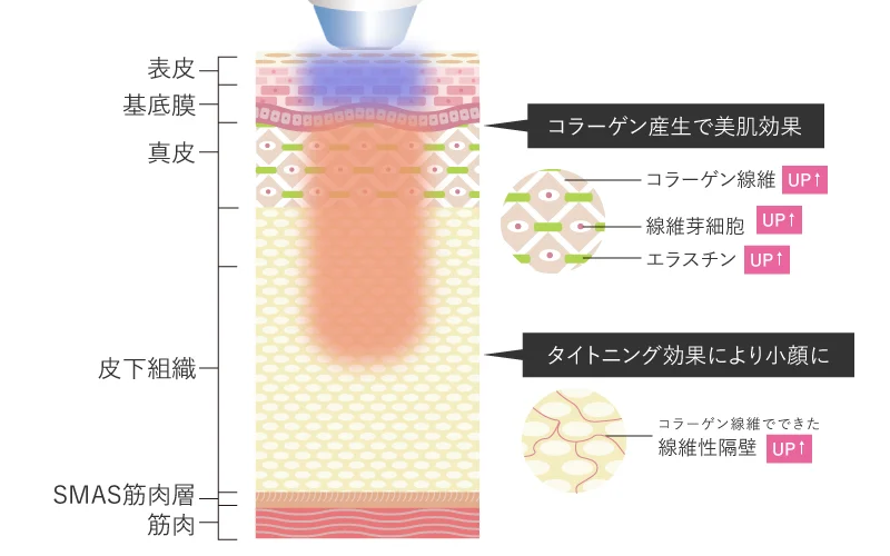 サーマクールFLX（高周波・たるみ治療）自由が丘クリニック【公式】