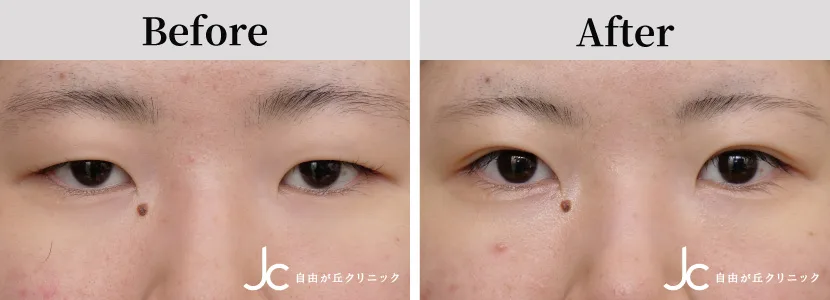 埋没法の症例写真