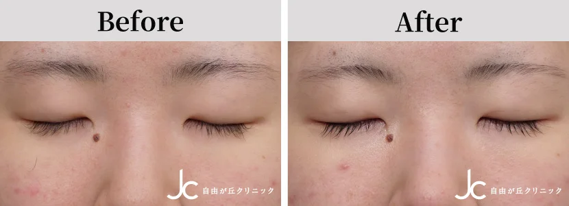 埋没法の症例写真