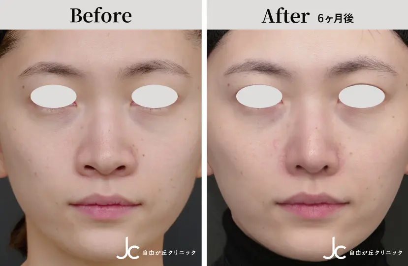 鼻の手術の症例写真