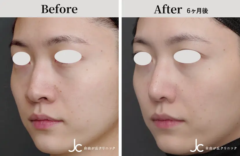 鼻の手術の症例写真