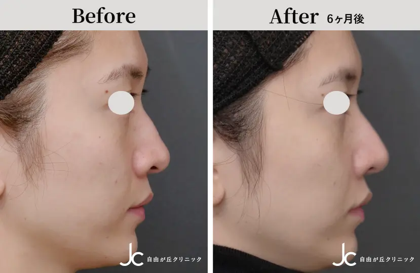 鼻の手術の症例写真