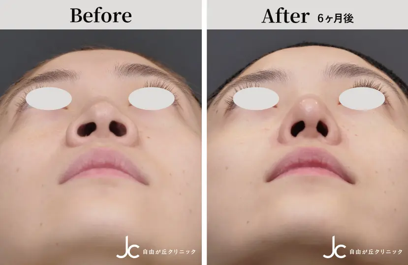 鼻の手術の症例写真