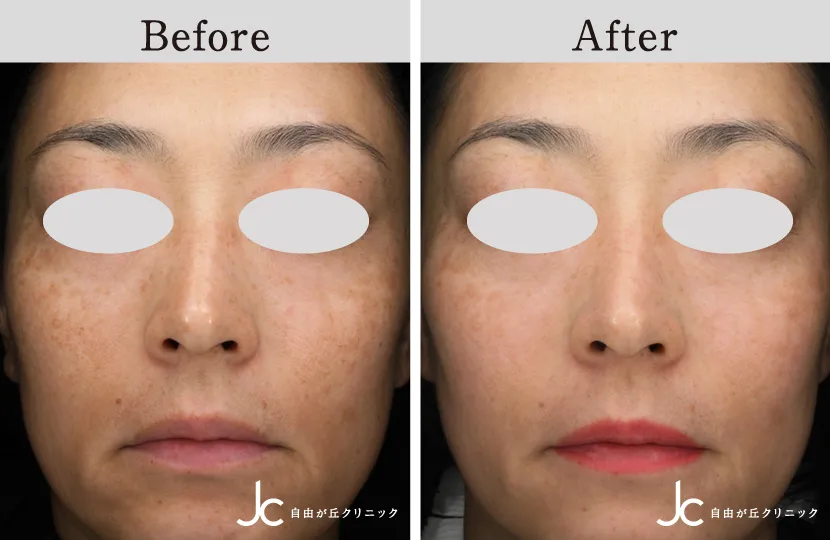 高濃度W-PRP療法×シルファームXの症例写真