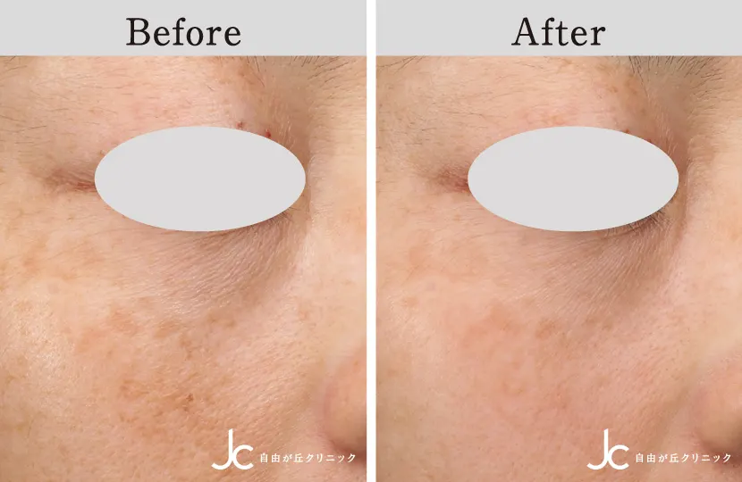 高濃度W-PRP療法×シルファームXの症例写真