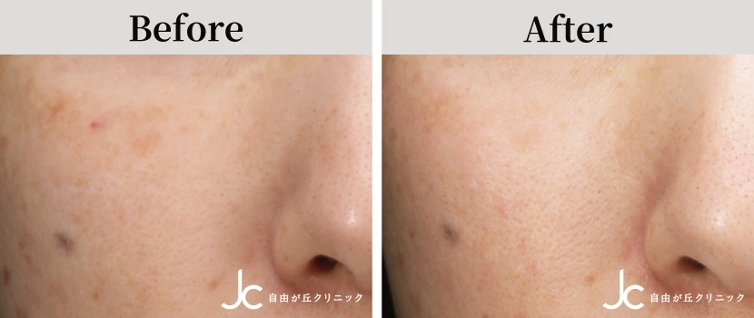 高濃度W-PRP療法×シルファームXの症例写真