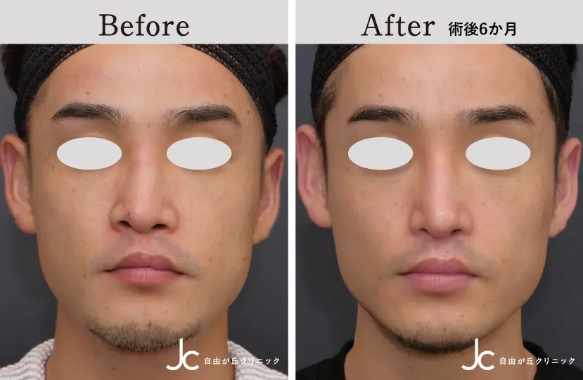 口唇裂の症例写真