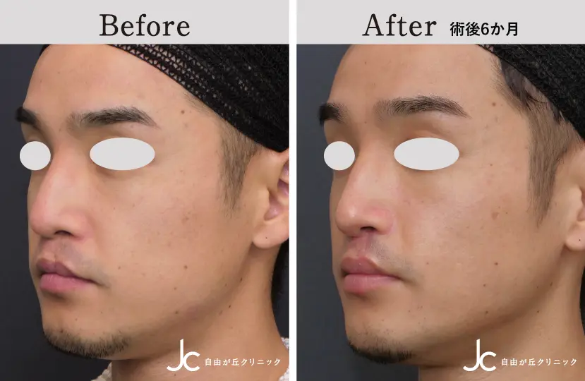 口唇裂の症例写真