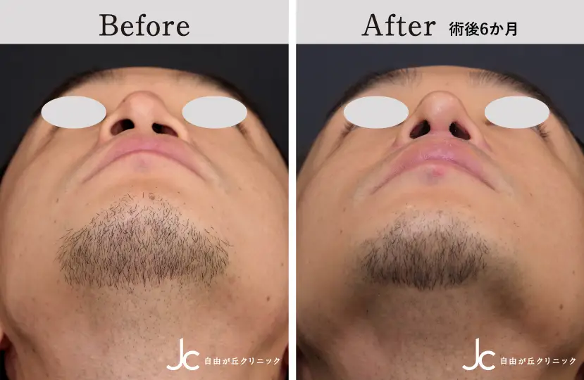 口唇裂の症例写真