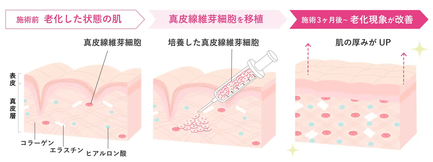 真皮線維芽細胞療法（肌の再生医療）なら自由が丘クリニック
