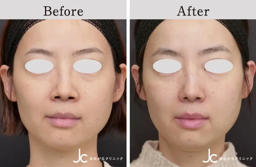 鼻の手術の症例写真