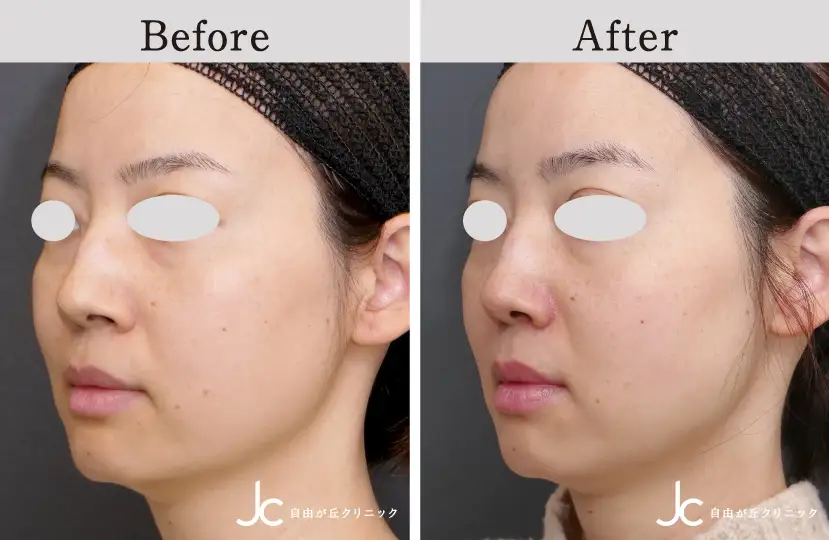 鼻の手術の症例写真