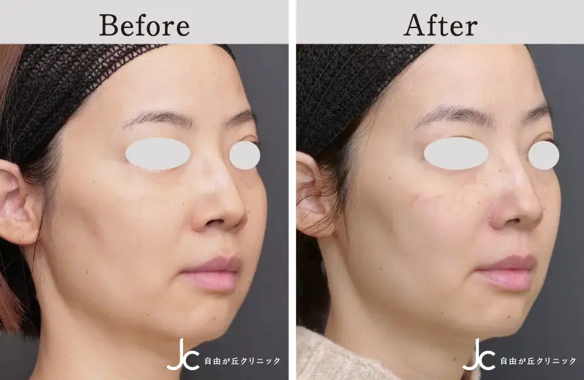 鼻の手術の症例写真