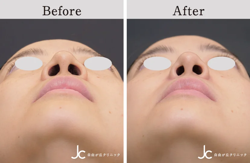 鼻の手術の症例写真