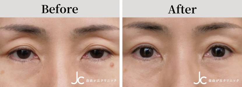 眼瞼下垂の症例写真