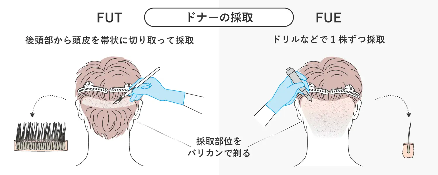 ドナーの採取方法の図解イラスト
