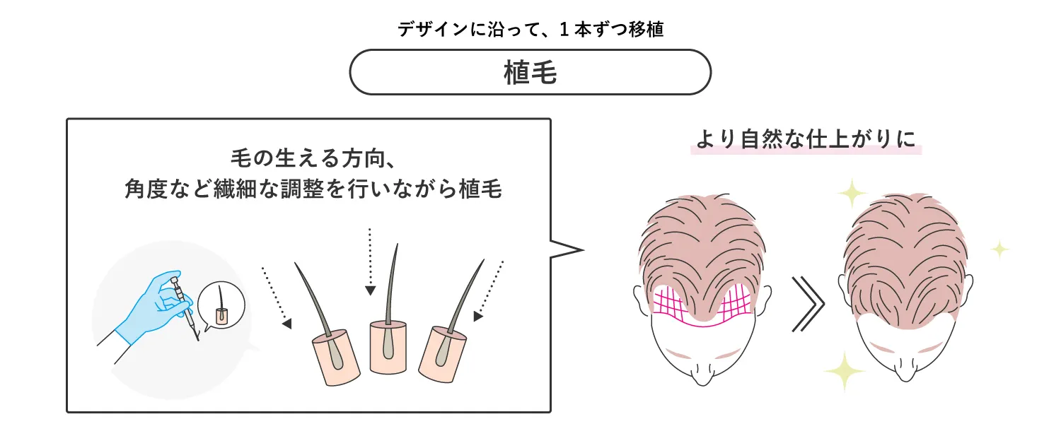 植毛についての図解イラスト
