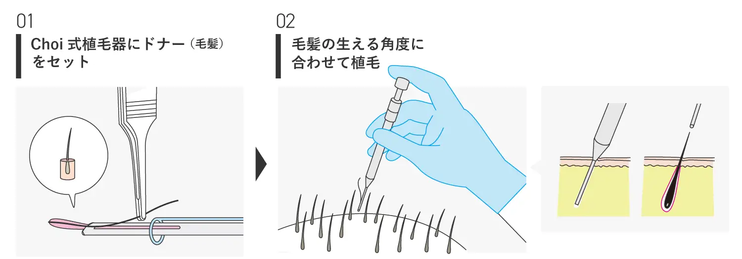 choi式についての図解イラスト