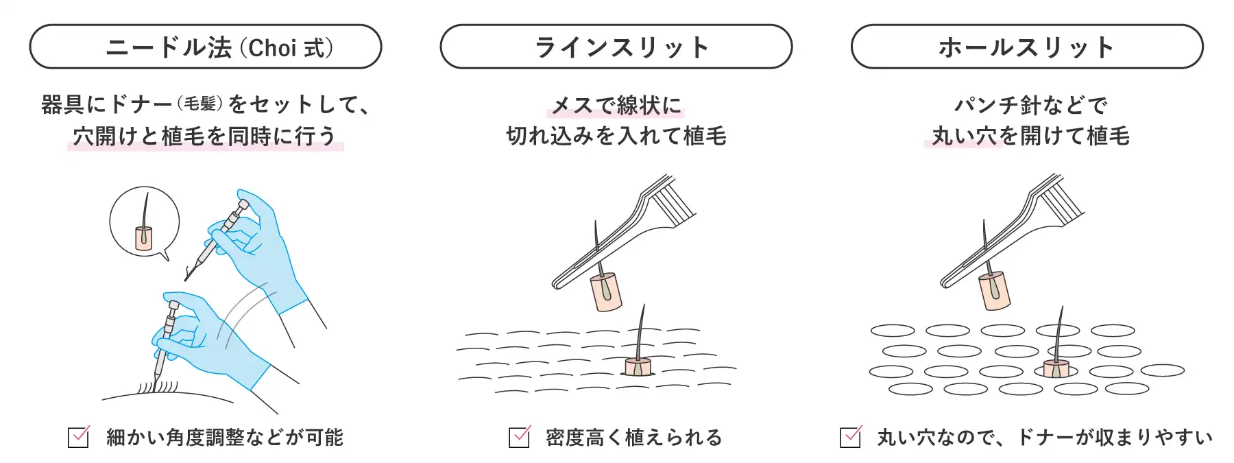 植毛方法の図解イラスト