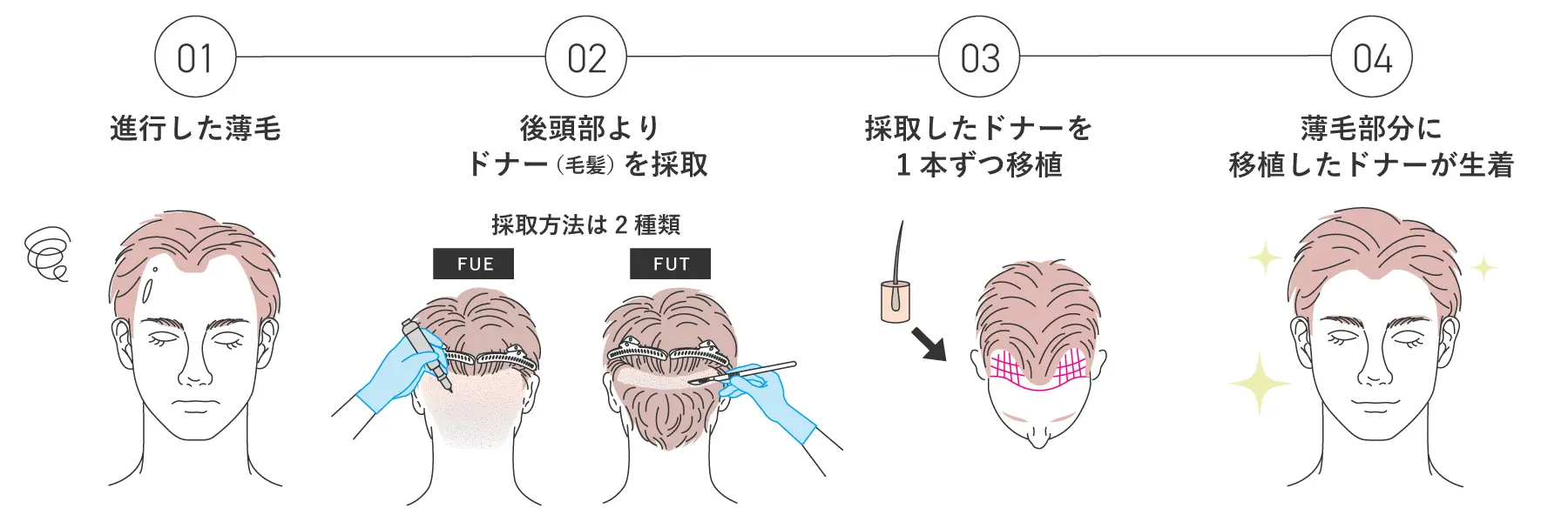 植毛の流れの図解イラスト