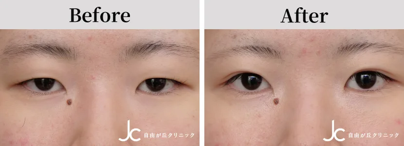 埋没の症例写真