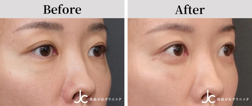 下まぶたのたるみ取りの症例写真
