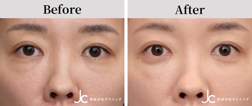 下まぶたのたるみ取りの症例写真