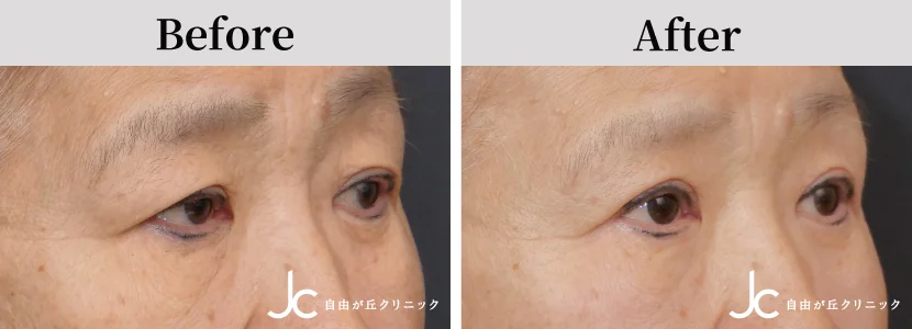 眼瞼下垂の症例写真