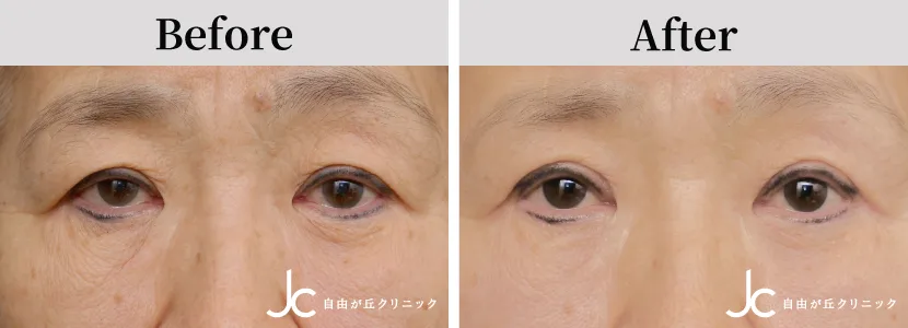 眼瞼下垂の症例写真