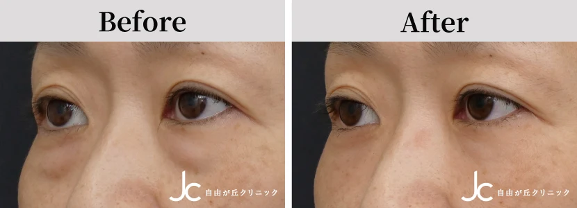 下まぶたのたるみ取りの症例写真