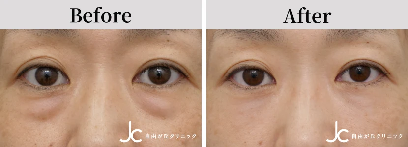 下まぶたのたるみ取りの症例写真