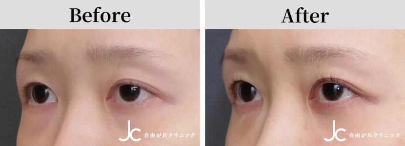 眼瞼下垂の書例写真