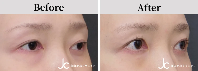 眼瞼下垂の書例写真