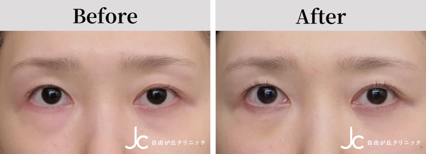 眼瞼下垂の書例写真