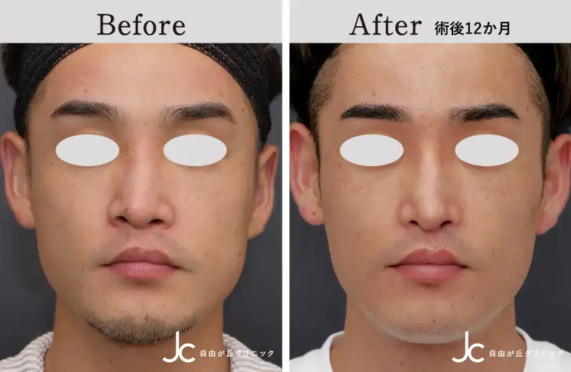 口唇裂の症例写真