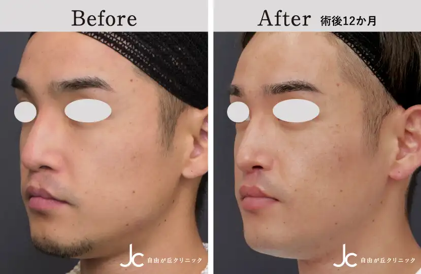 口唇裂の症例写真