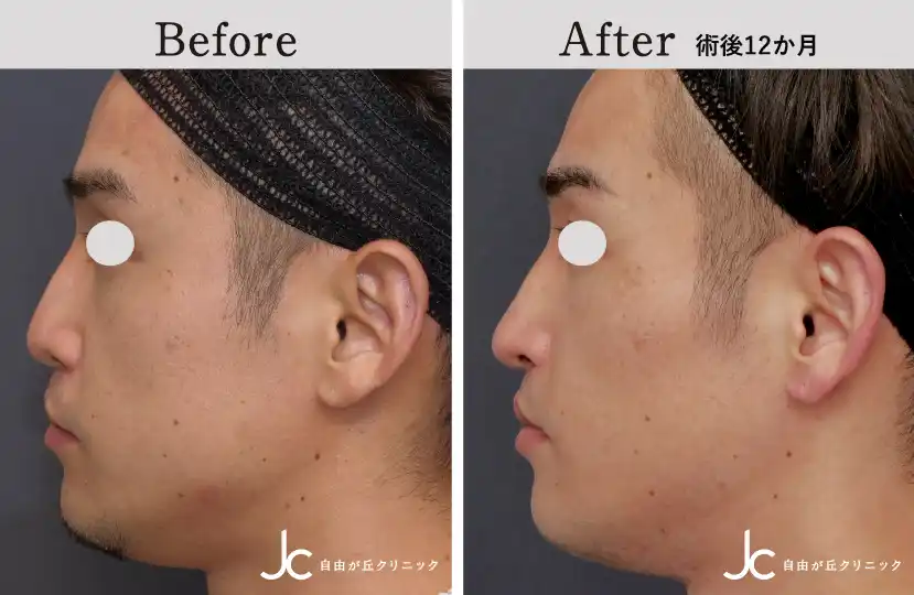 口唇裂の症例写真