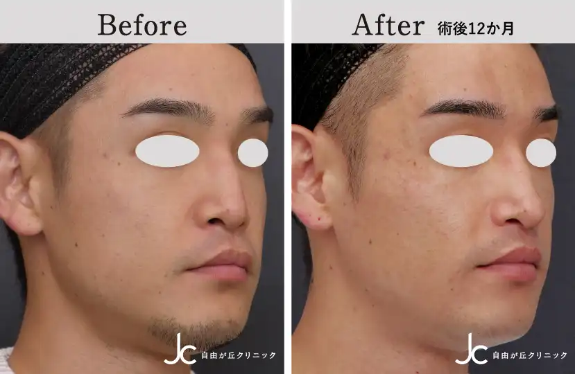 口唇裂の症例写真