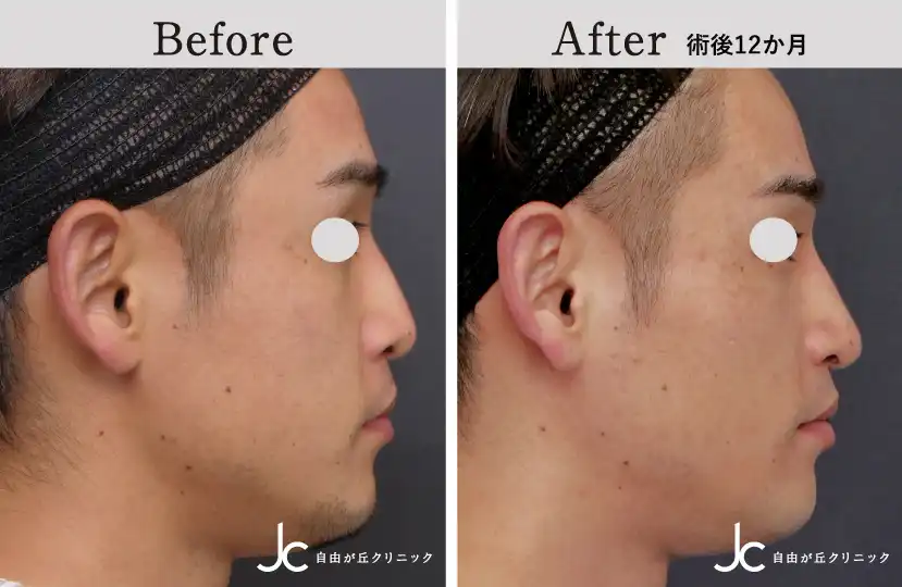 口唇裂の症例写真