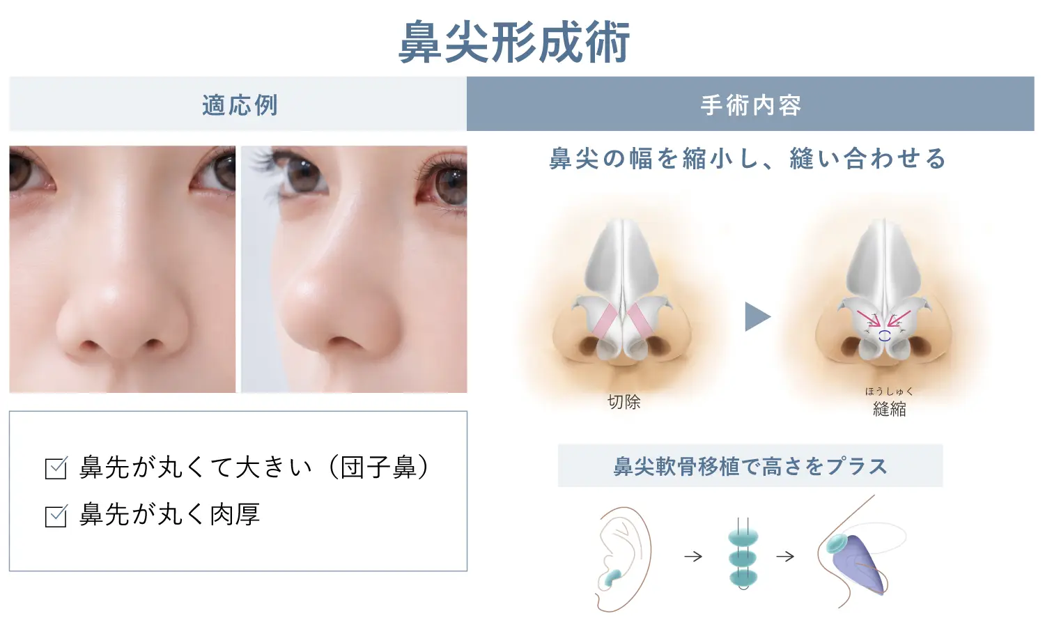 鼻尖形成術