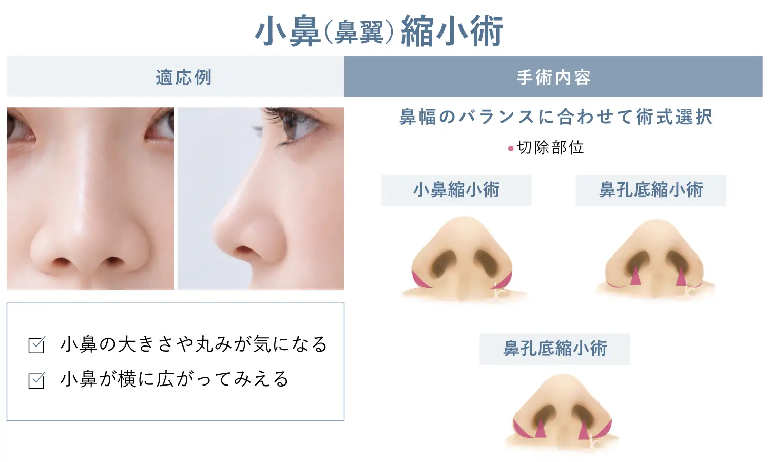 小鼻縮小術